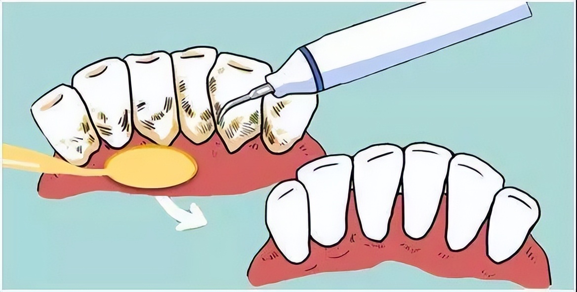 Teeth are sensitive after cleaning, whose fault is it? iNEWS