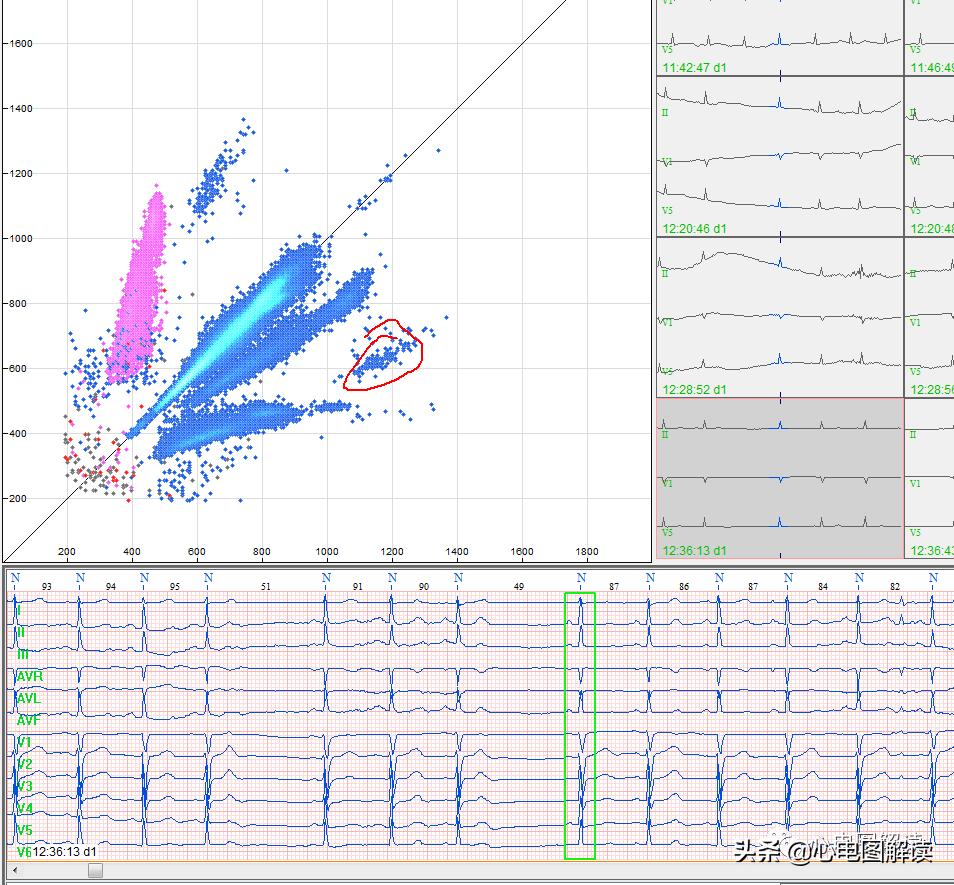 Atrial premature beat, atrial premature beat, scatter plot iNEWS