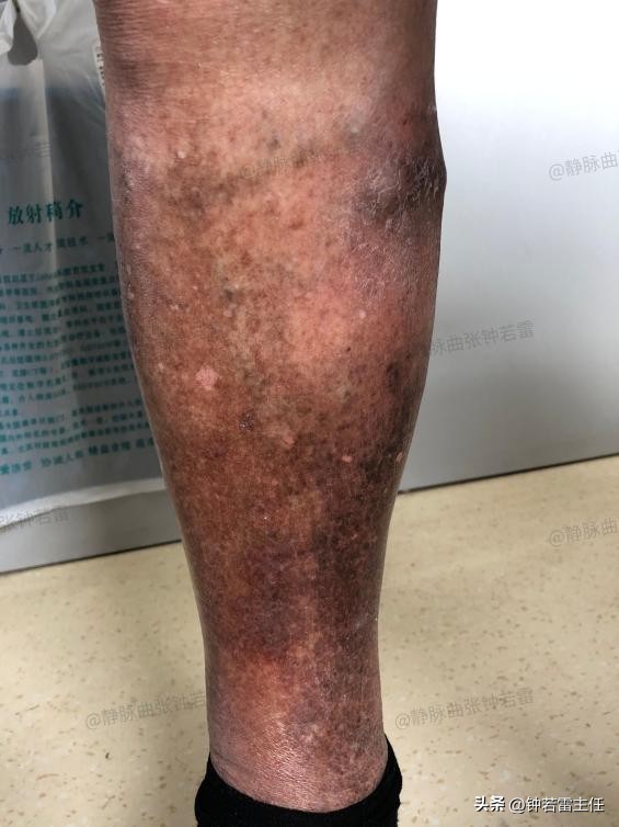 The calf is ulcerated, itchy, extremely red and swollen, and the dermatology department has been