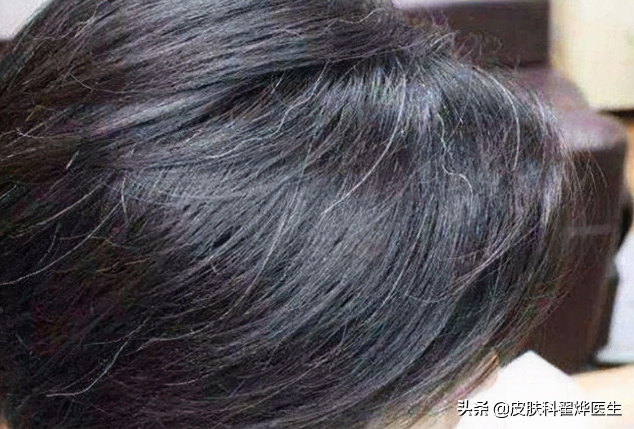 What vitamin deficiency can cause gray hair?Can white hair be pulled out?read or understand iNEWS