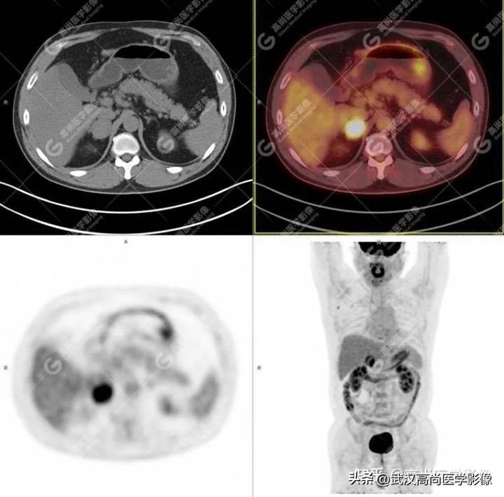 PET/CT-MR Multimodal Imaging: Pheochromocytoma 