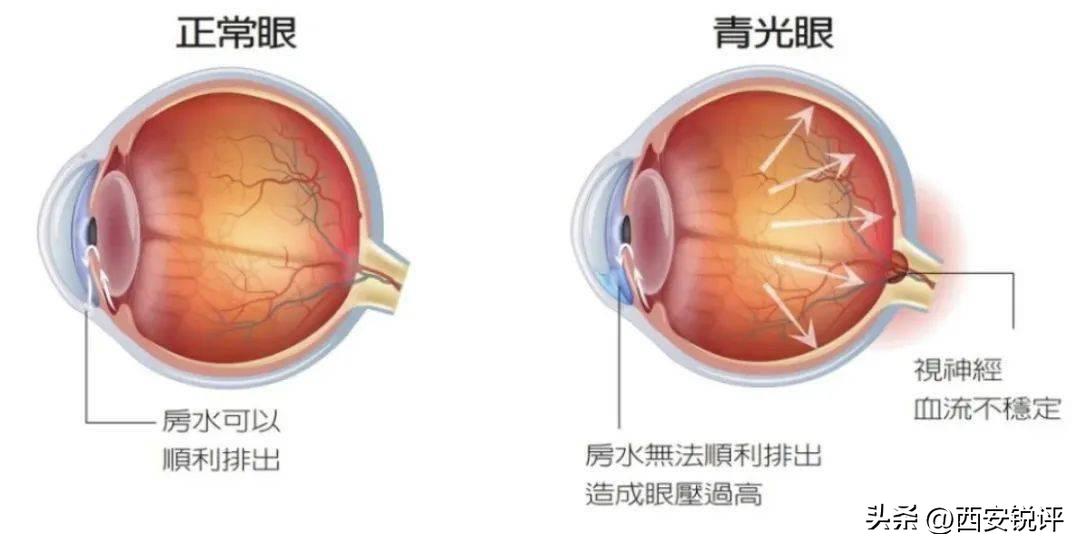 Visual Function Damage Seek medical attention if you have these symptoms! Turning off the ...