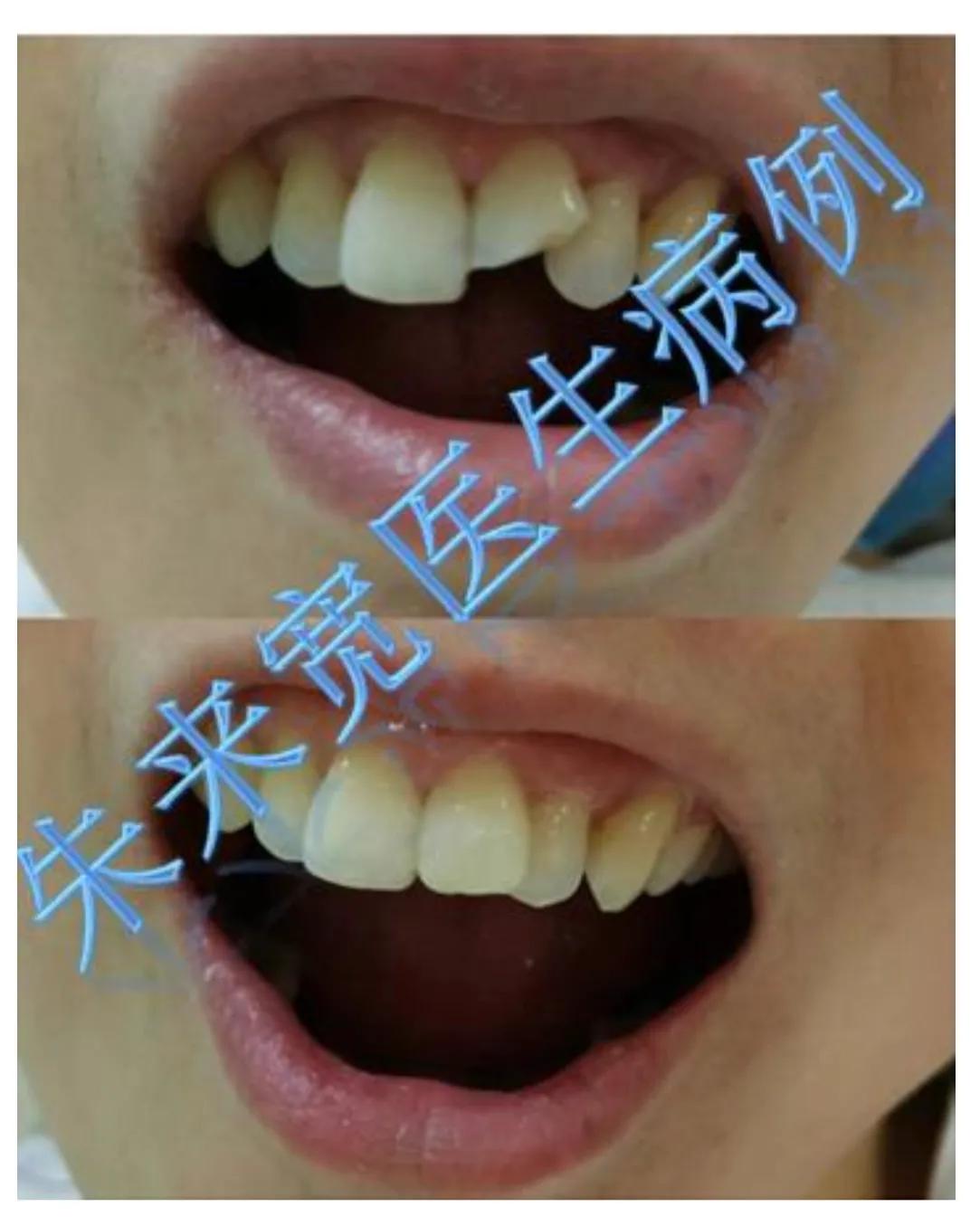 Dental Adventures (Episode 7) The permanent tooth was bruised iNEWS