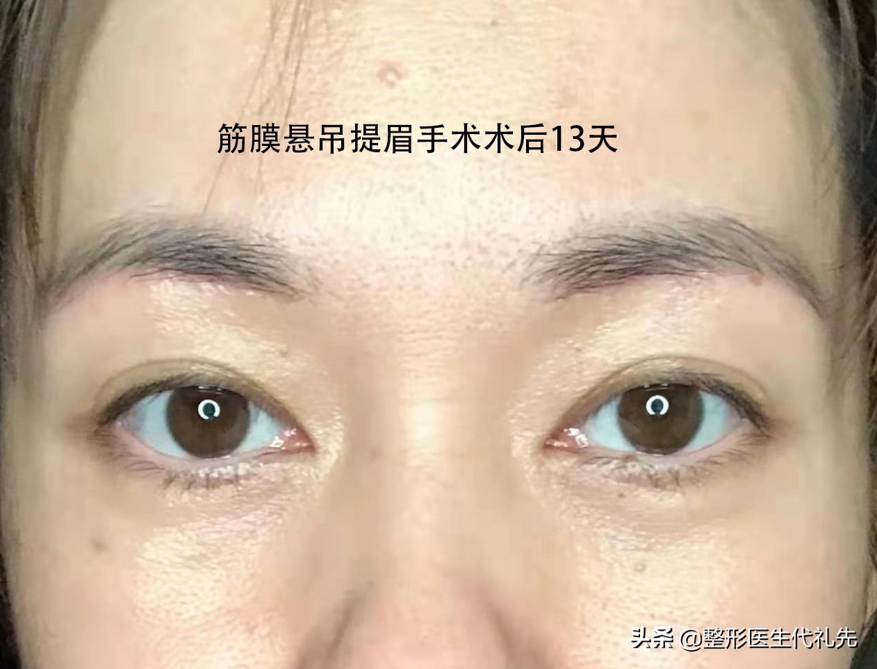 This is my fascial suspension brow lift before surgery 13 days after