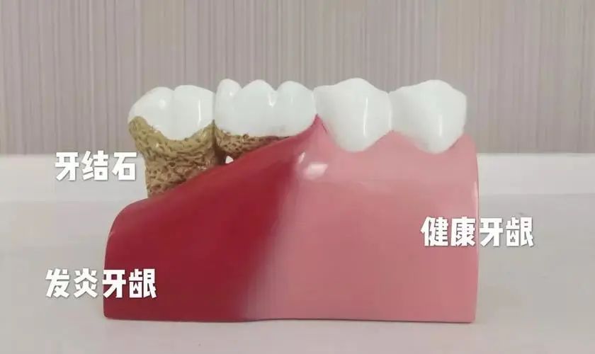 Teeth are sensitive after cleaning, whose fault is it? iNEWS