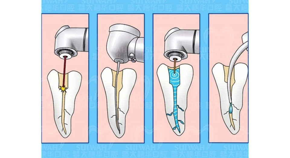 why-can-t-some-cavities-be-filled-directly-take-you-to-reveal-the