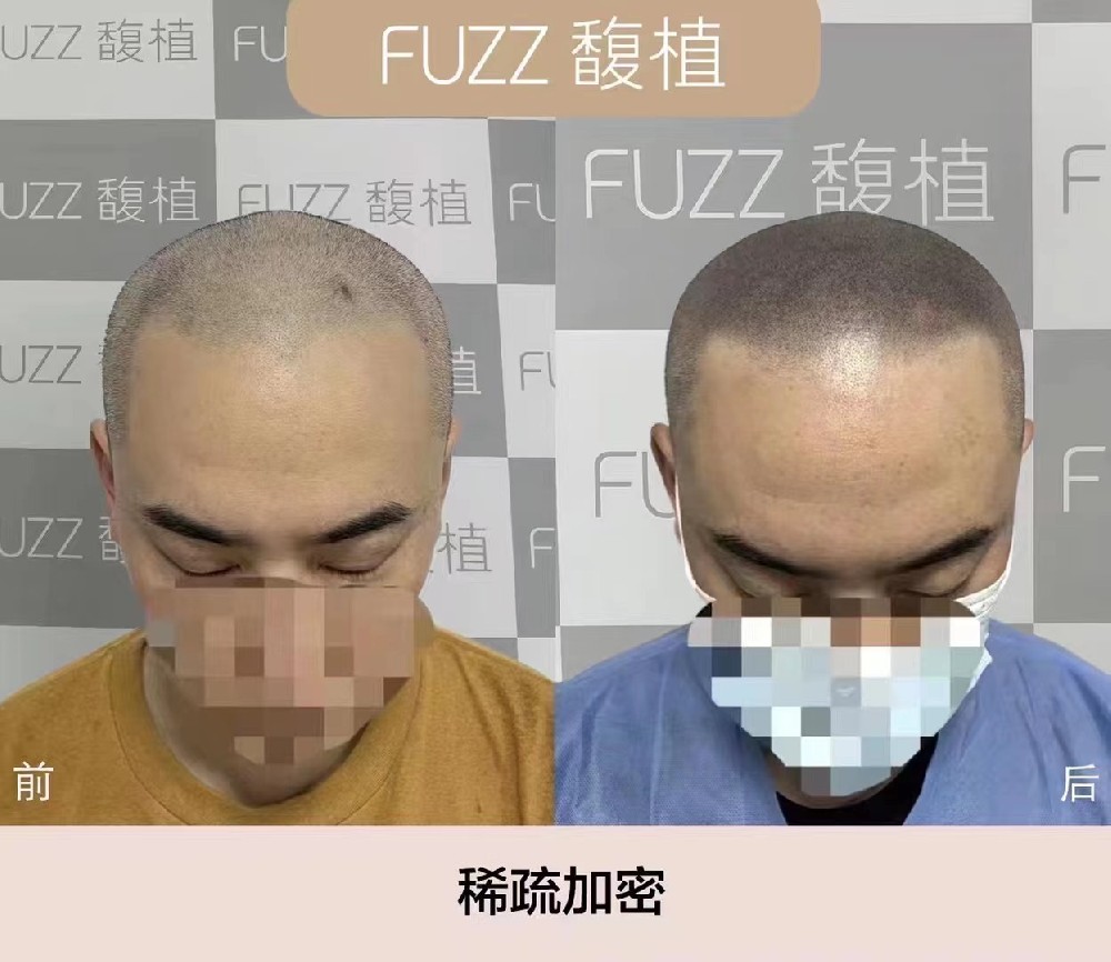 How long can a tattoo last? What is the real effect of hair tattoo? iNEWS