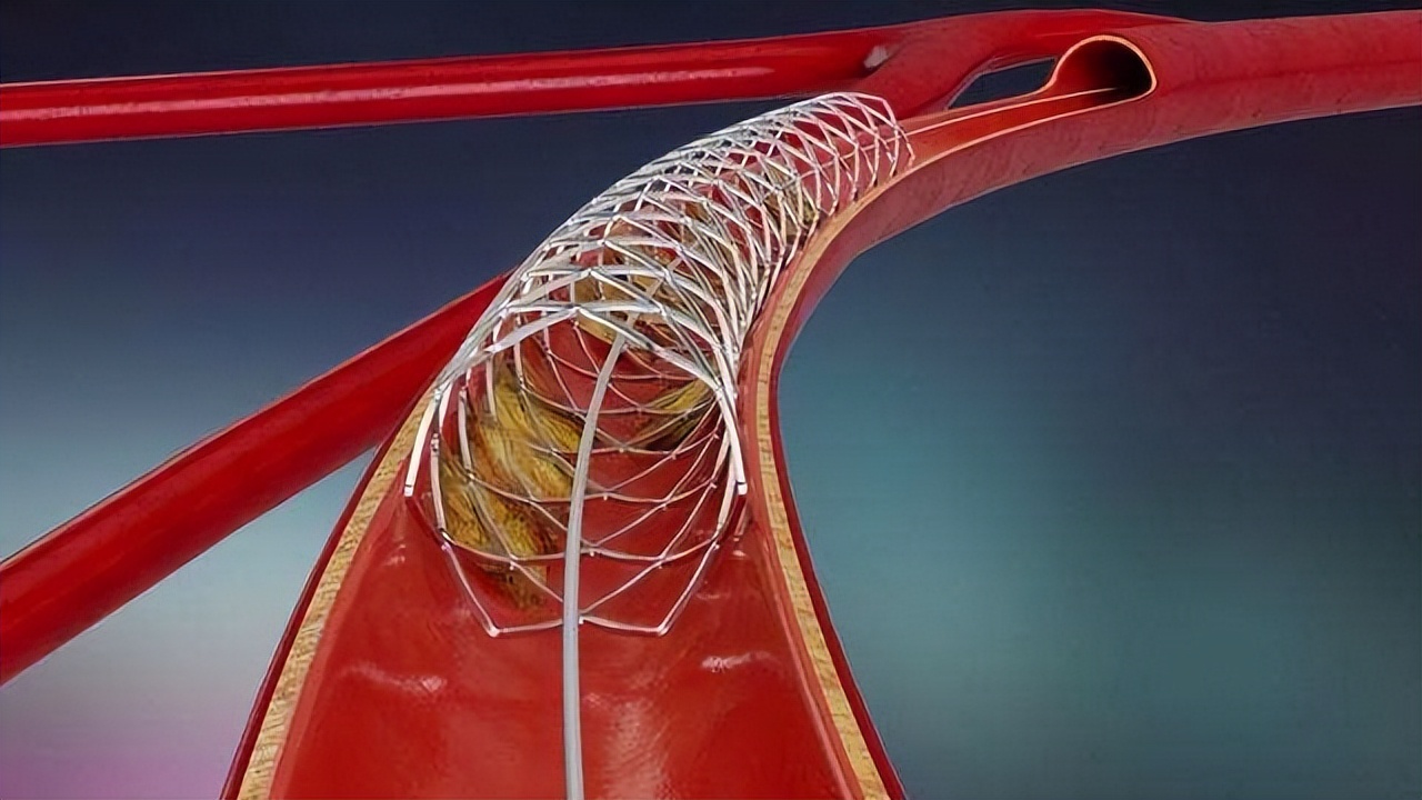Will the installation of a heart stent affect the human body?How do you