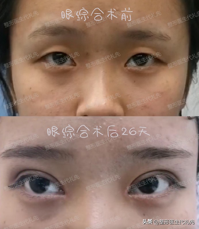 What are the causes of sunken eyes? What kind of surgery should be done
