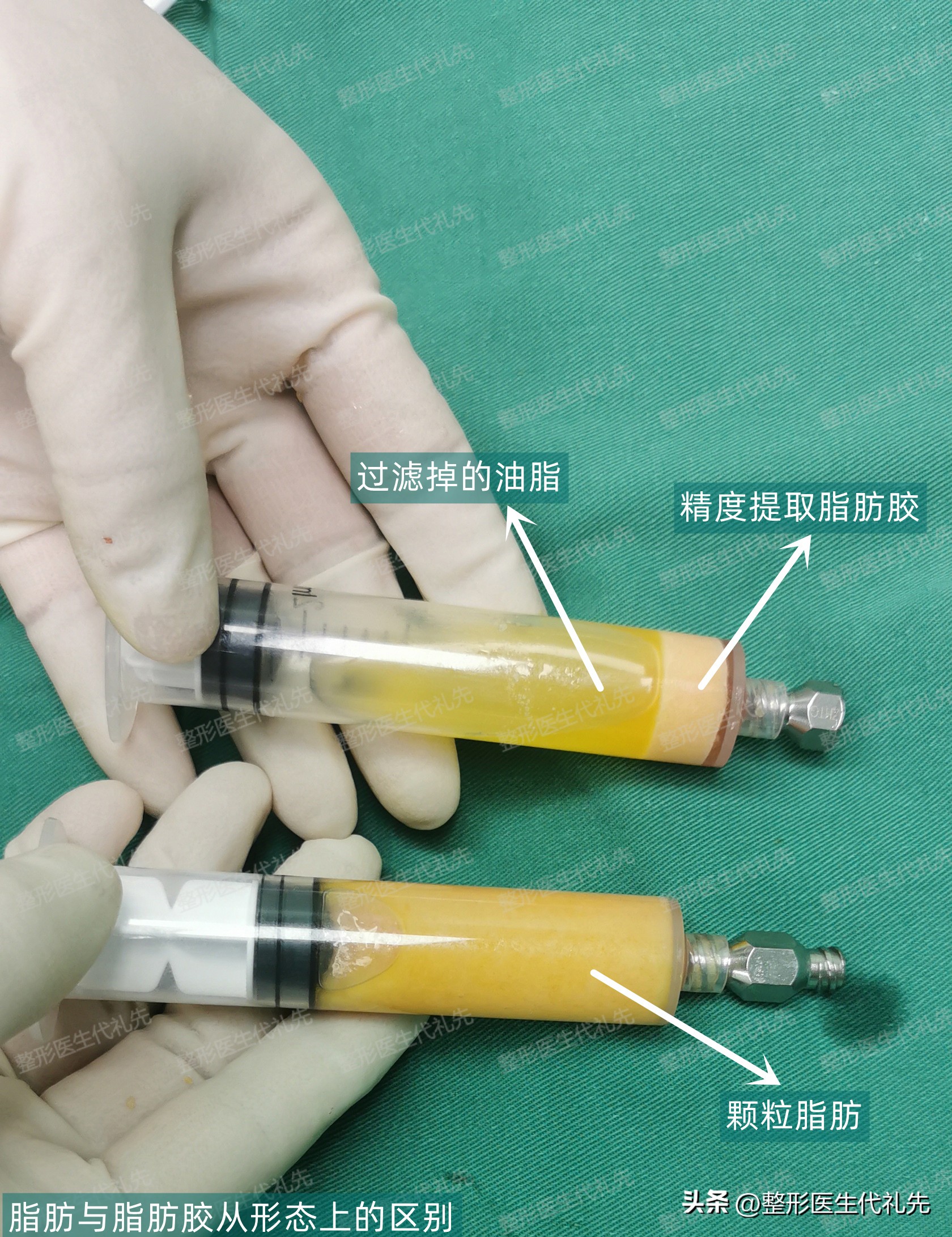 The 54-year-old woman had these changes in her eyes before and after ...