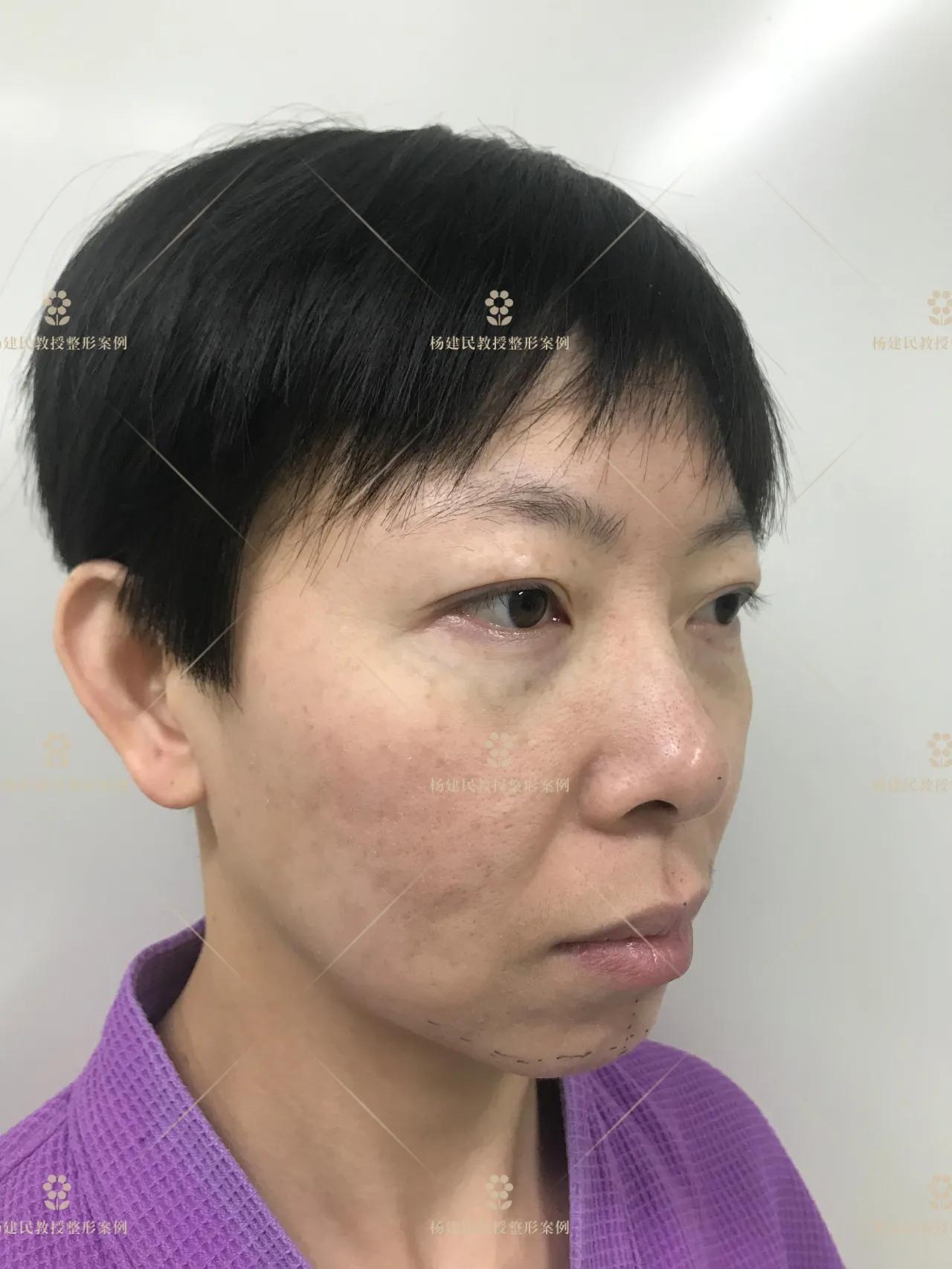 Autologous Fat Grafting for Facial Contouring iNEWS