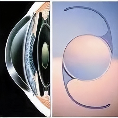 Two Focus Single focus, bifocal, triple focus, what is the difference between ...