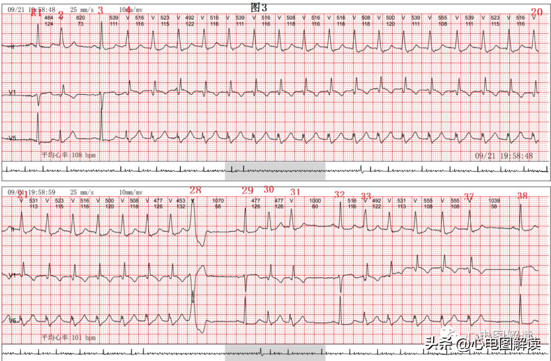 Two cases of premature ventricular contractions and ventricular ...