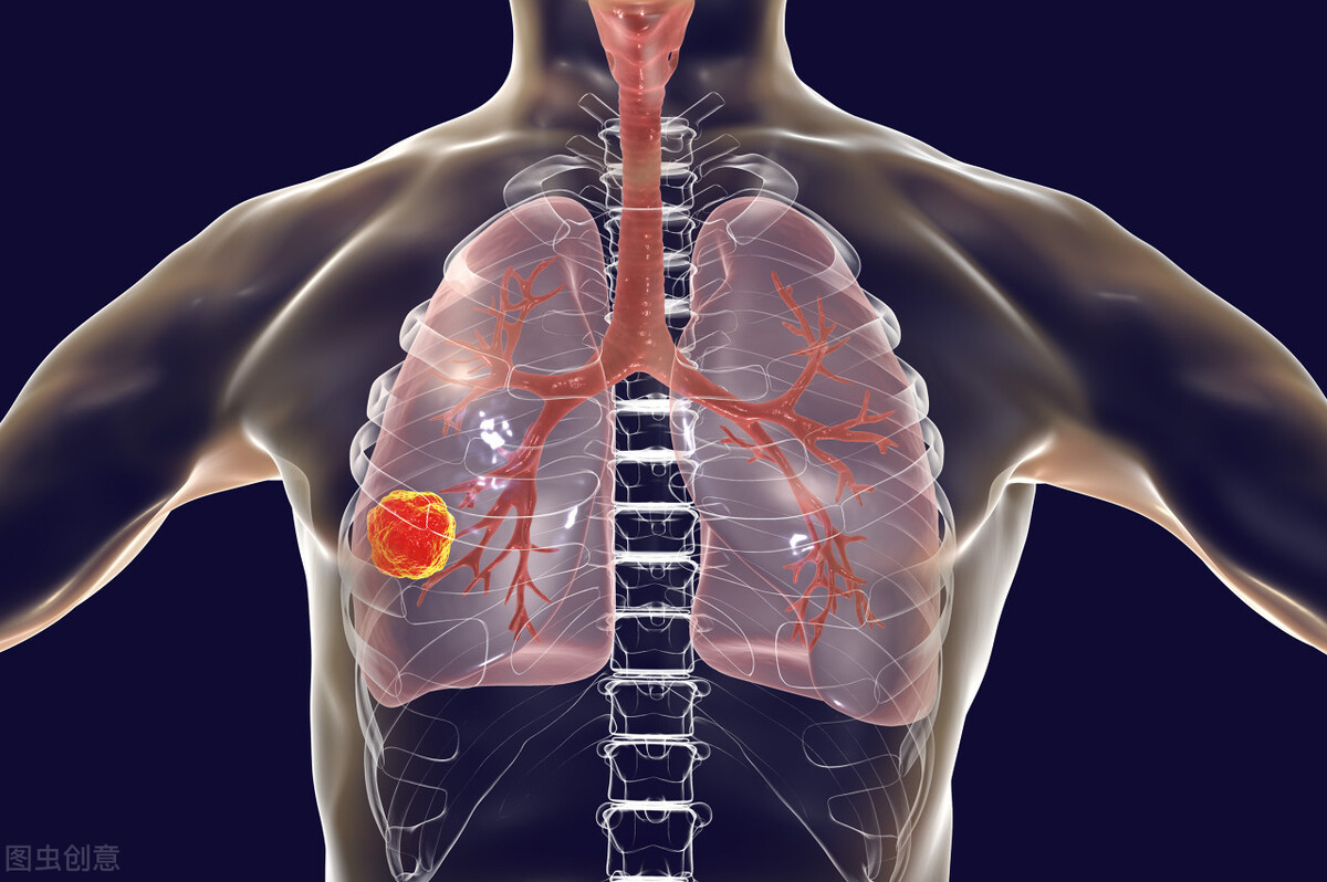 Lung adenocarcinoma surgery, radiotherapy and chemotherapy, which one ...