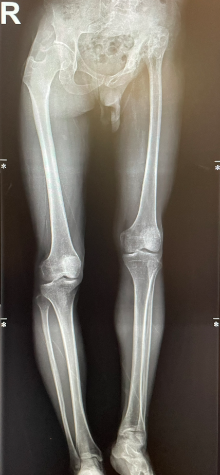 The infection left behind sequelae at a young age, and the 35-year pain ...