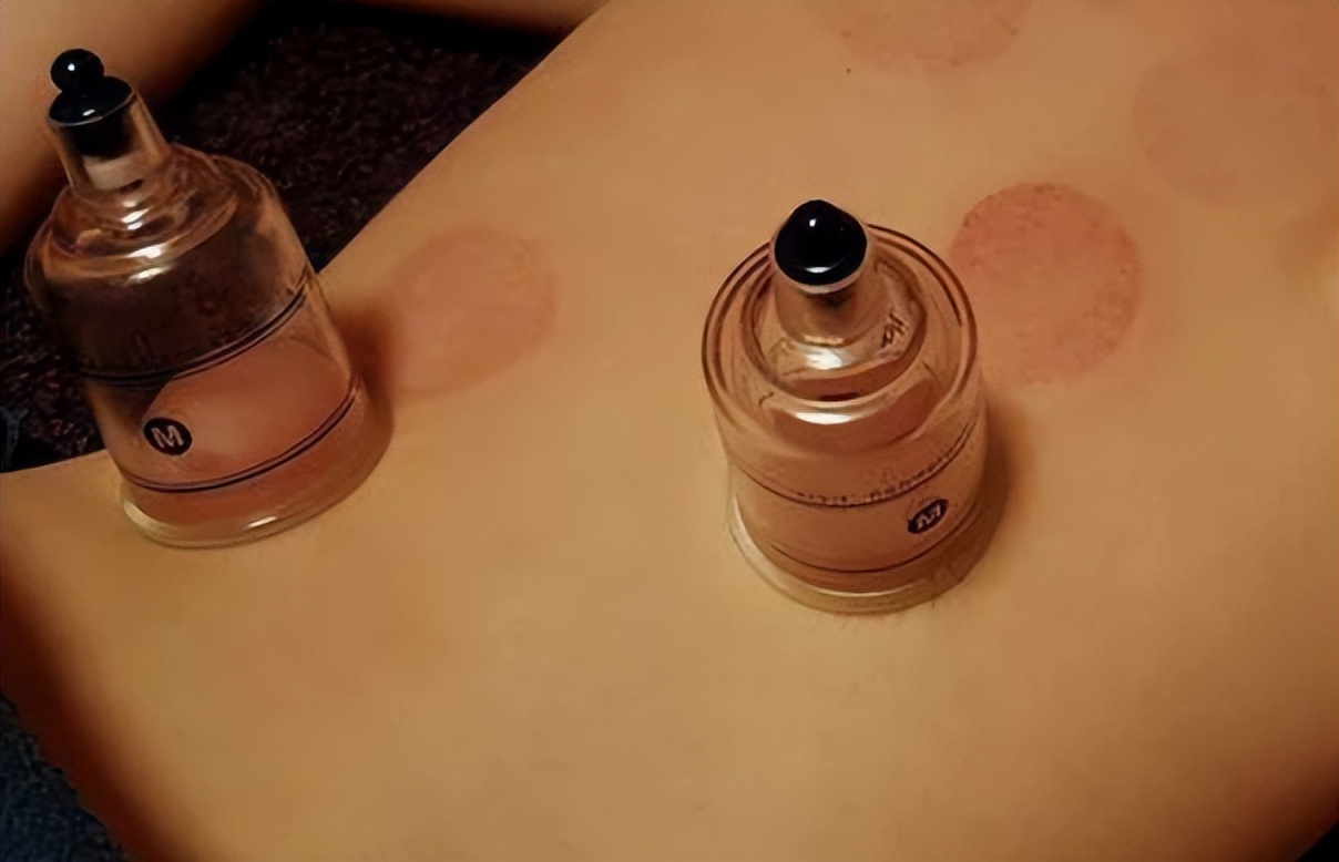 Can cupping and scraping be done at the same time? When to do it, it ...