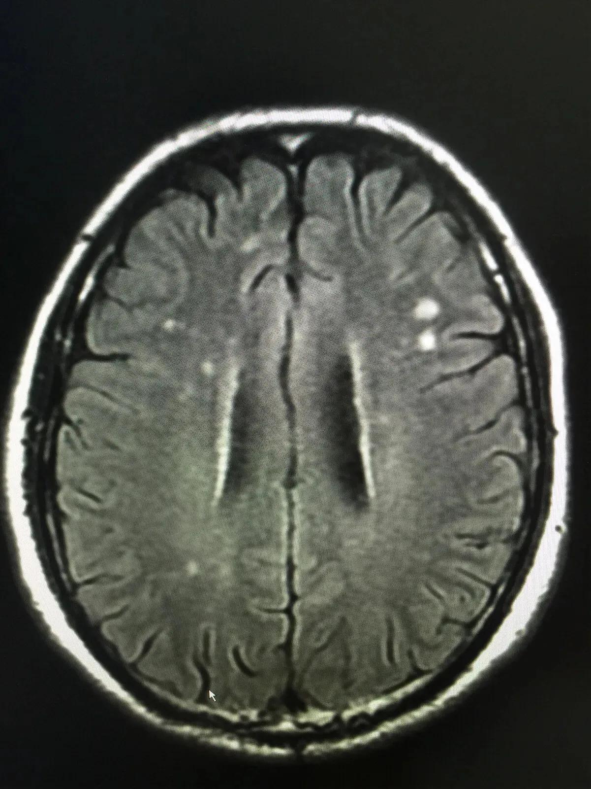 Cerebral infarction and lacunar infarction, are they the same? - iNEWS