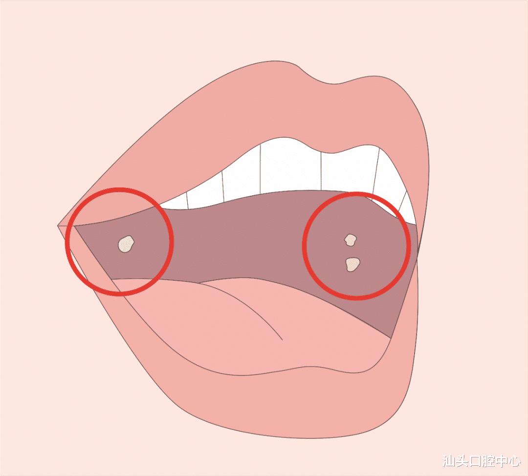 Choose C or B? Which vitamins should be supplemented for oral ulcers