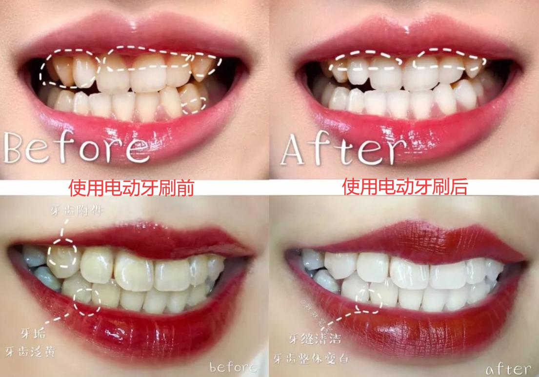 Can I use an electric toothbrush for dental implants?Medical students