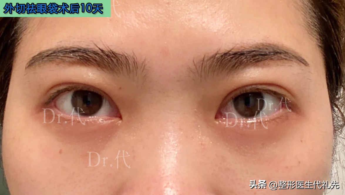 Heavy bags under the eyes? The reason turned out to be these! iMedia