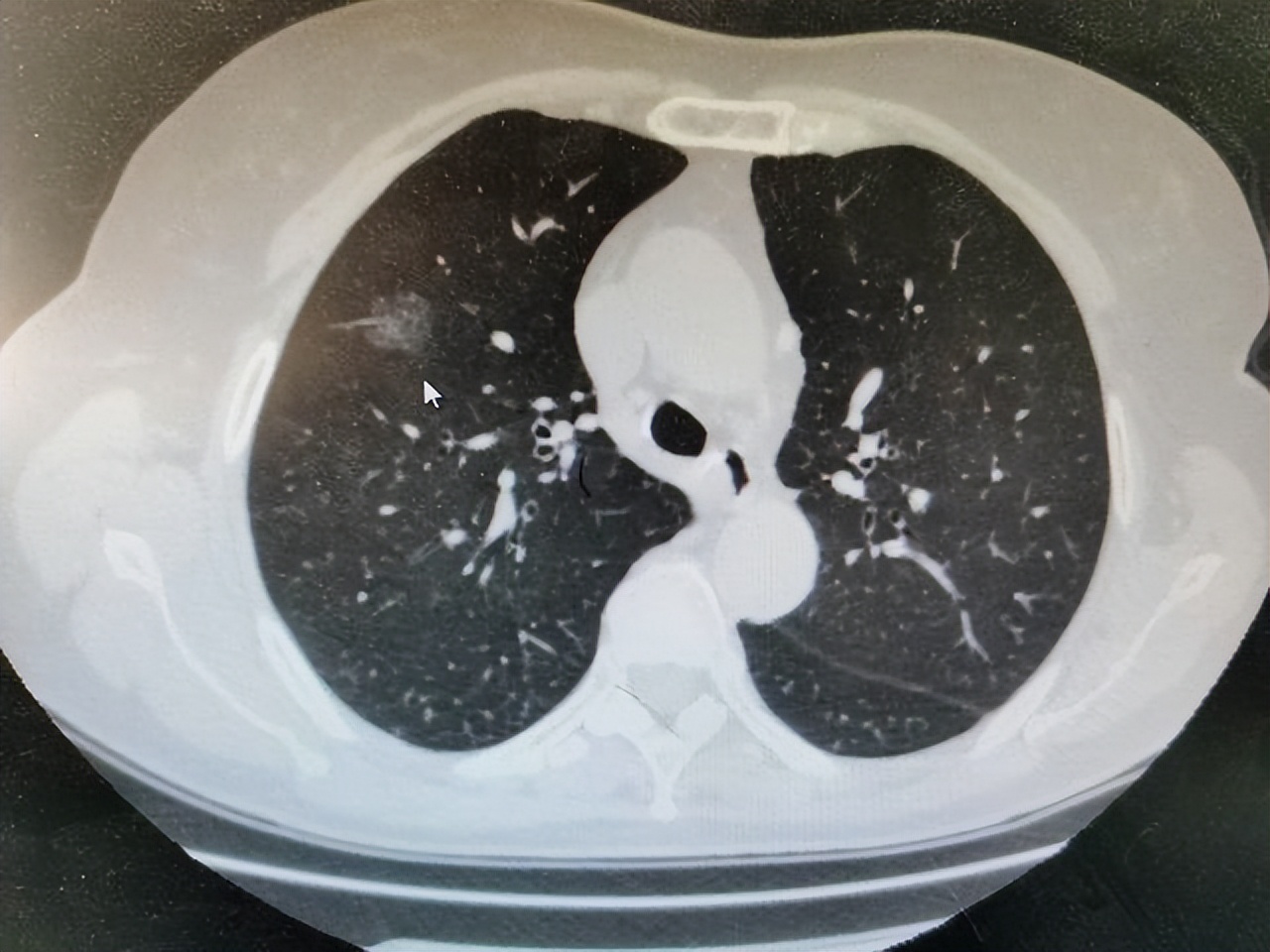 Are eggs the "hair" of lung nodules?Reminder If you want to nourish