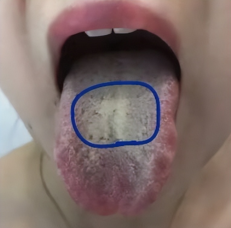 There are teeth marks on both sides of the tongue. Is it due to spleen ...