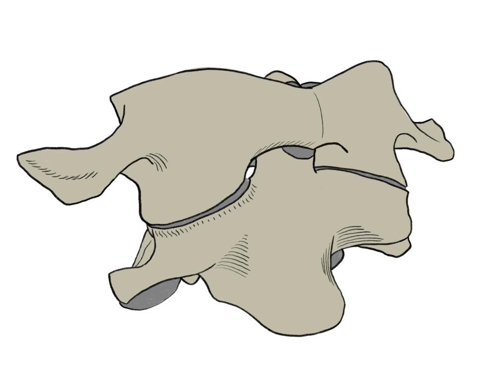 Discussion on the Treatment of Atlas Fracture from the Angle of Bionics ...
