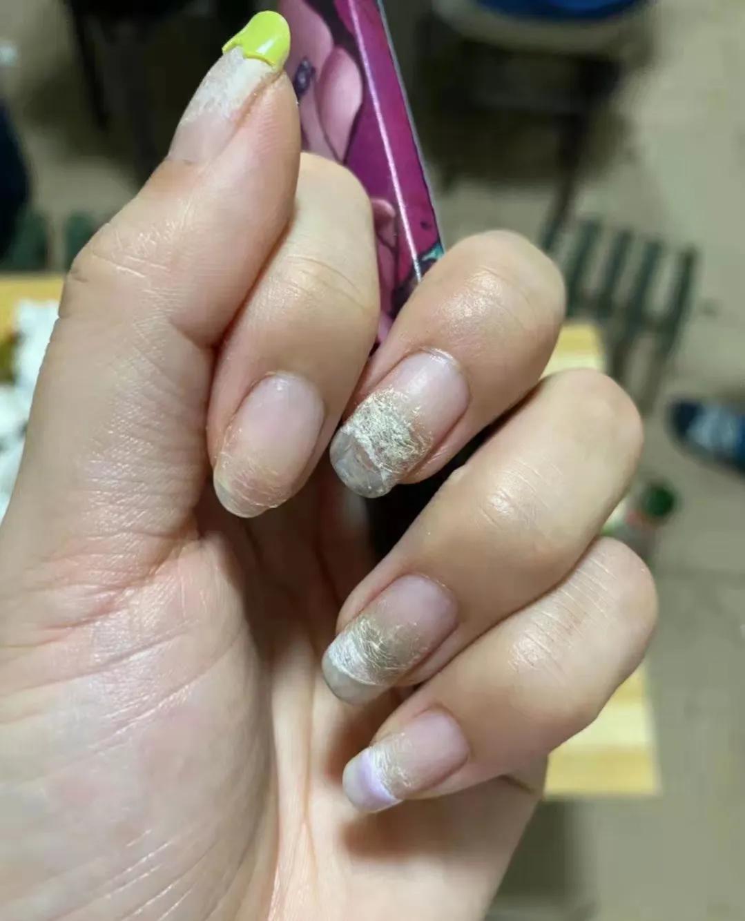 The dangers of longterm nail art, really don't do nails frequently