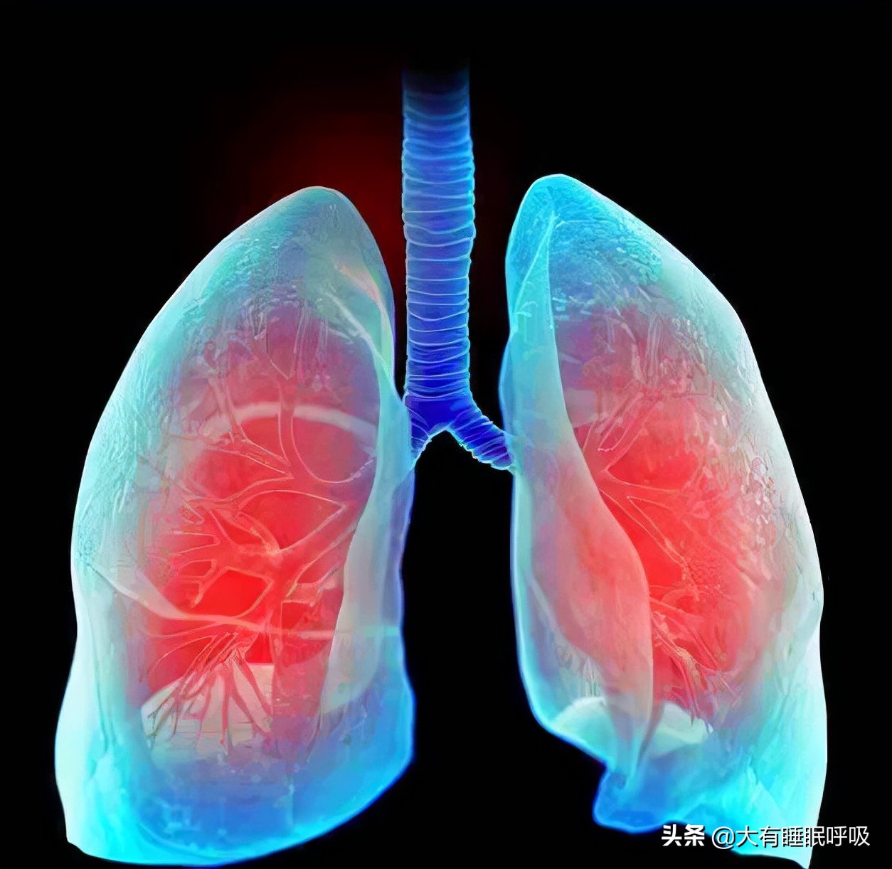 Chronic bronchitis, asthma, COPD, cor pulmonale, these stages of lung ...