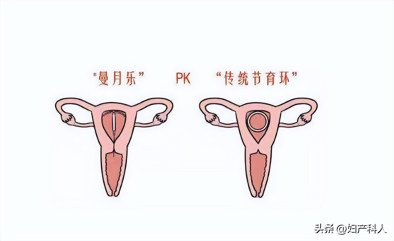 Wonderful Mirena iNEWS