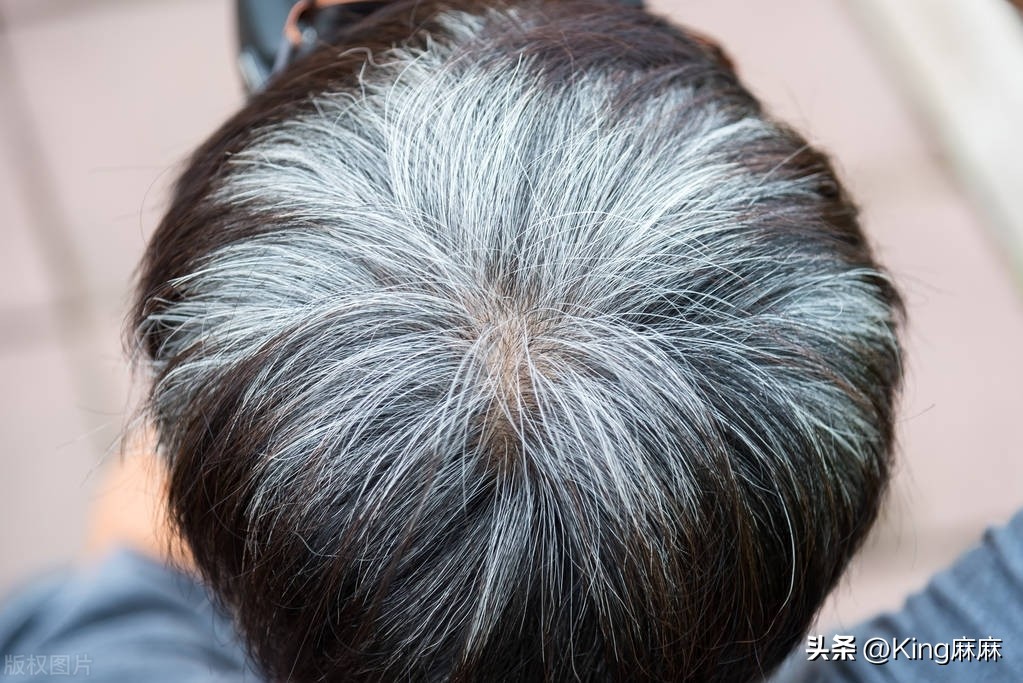 Why do white hair grow longer?After the age of 40, 2 kinds of nutrients