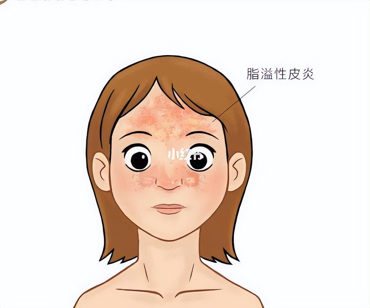 Diagnosis and treatment of seborrheic dermatitis iNEWS