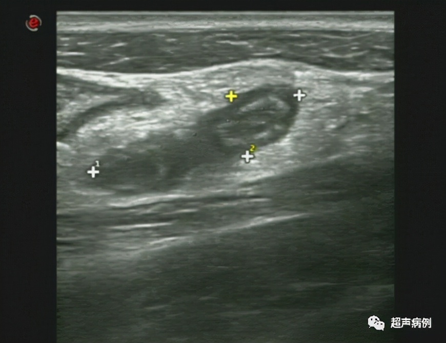 How does appendicitis look on ultrasound?What knowledge needs to be mastered?It's all summed up