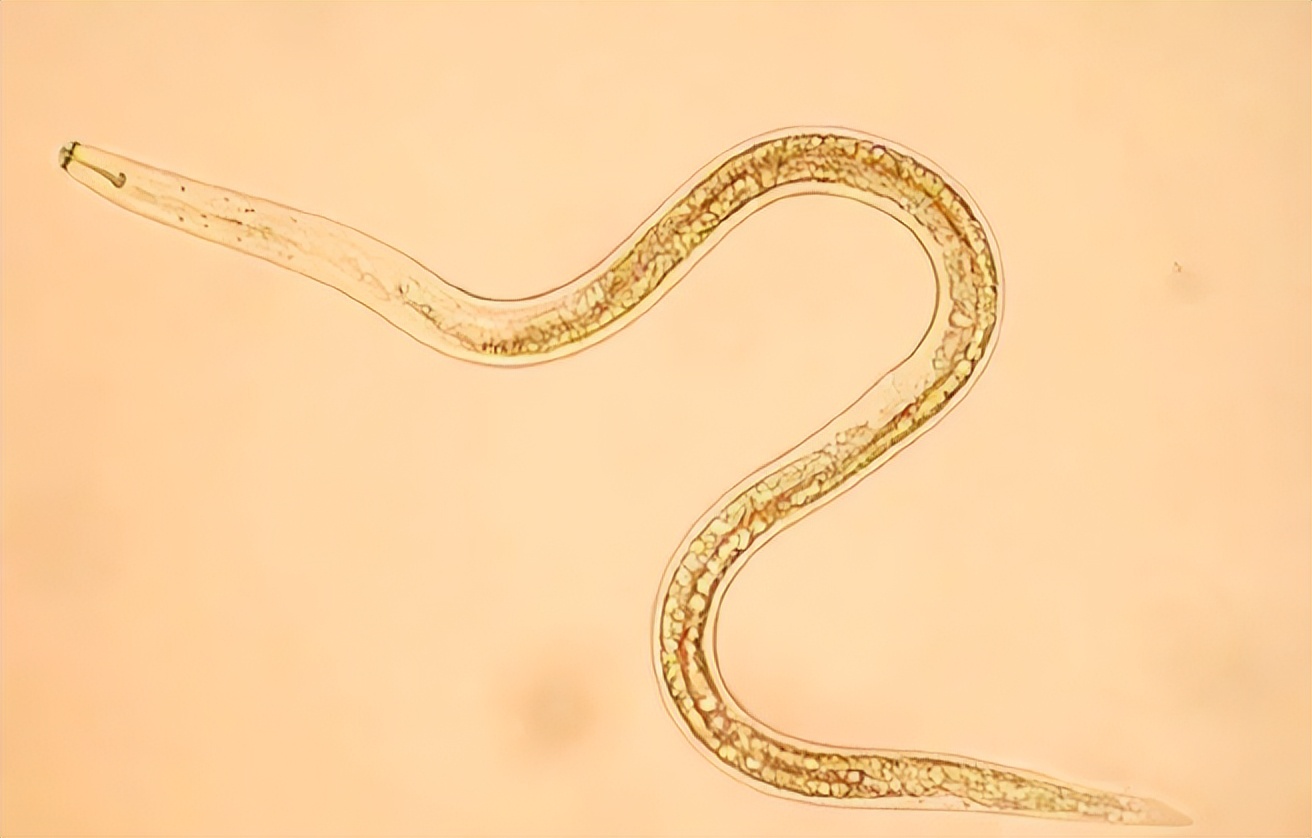 Horrible 1.2-meter-long parasite invades the human body and ravages ...