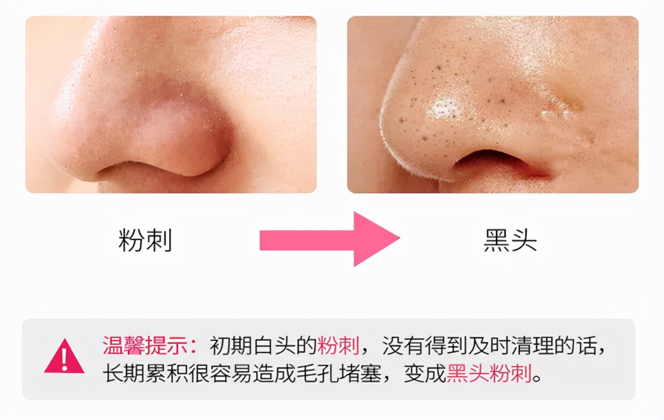 How to tell if it's fat granules or acne? iNEWS