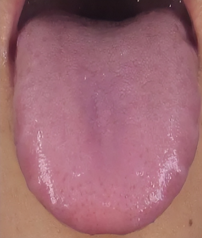 Teeth marks on the edge of the tongue?Dr. Li will tell you the cause