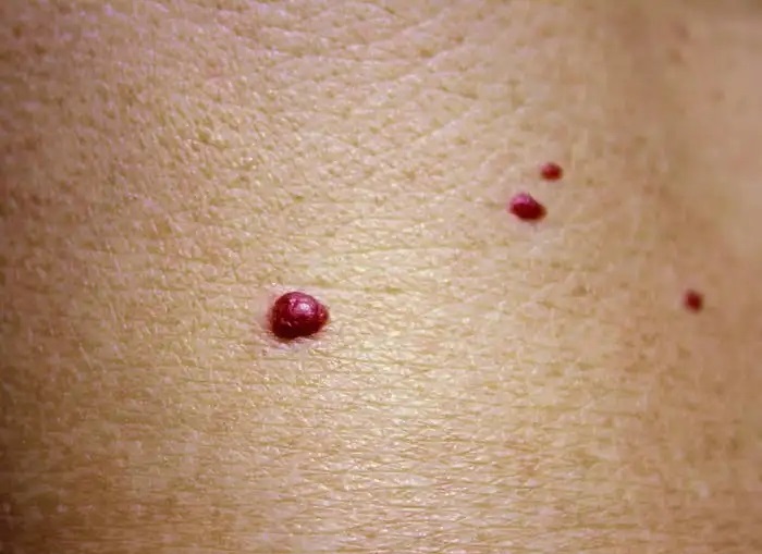 Repeatedly squeezing pimples and bleeding will not only cause ...