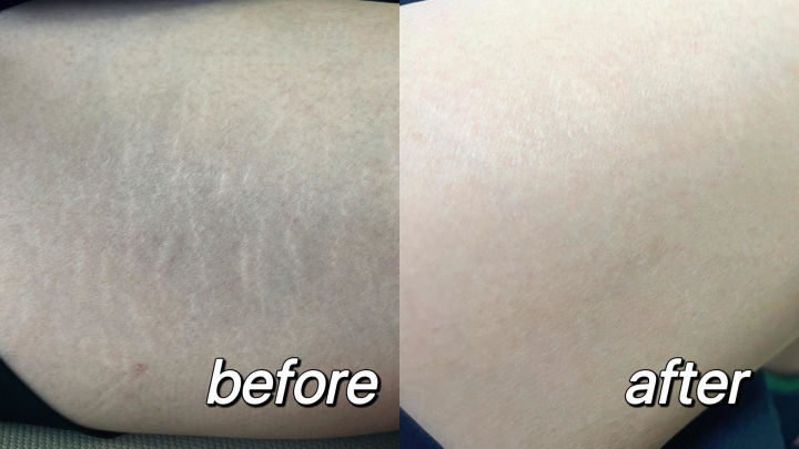 100 days to record the disappearance of fat lines!Listen to my advice ...