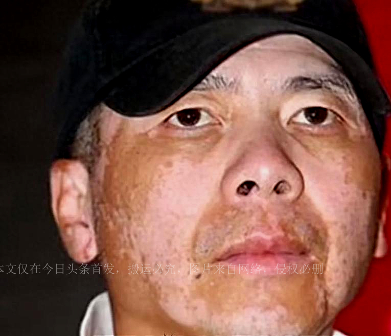 Feng Xiaogang's vitiligo disappeared in 17 years and his smooth face