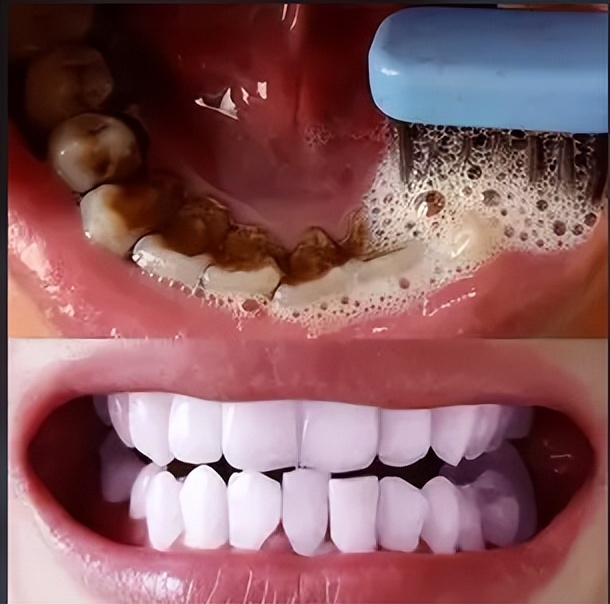 You can get rid of black teeth stains without quitting smoking!One more step before brushing