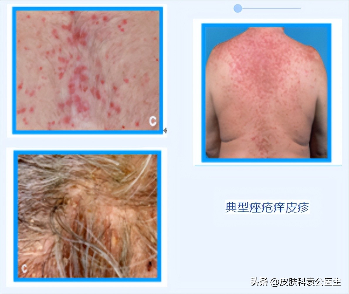 What should I do if I have a rash with targeted therapy? iNEWS