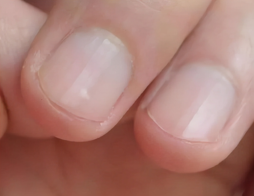 Why do fingernails have "vertical lines"?Several problems that often