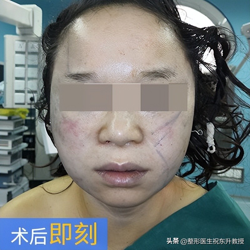 I had a facelift surgery without telling my family, the process was a