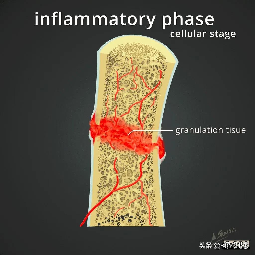 fracture healing process Biology Diagrams