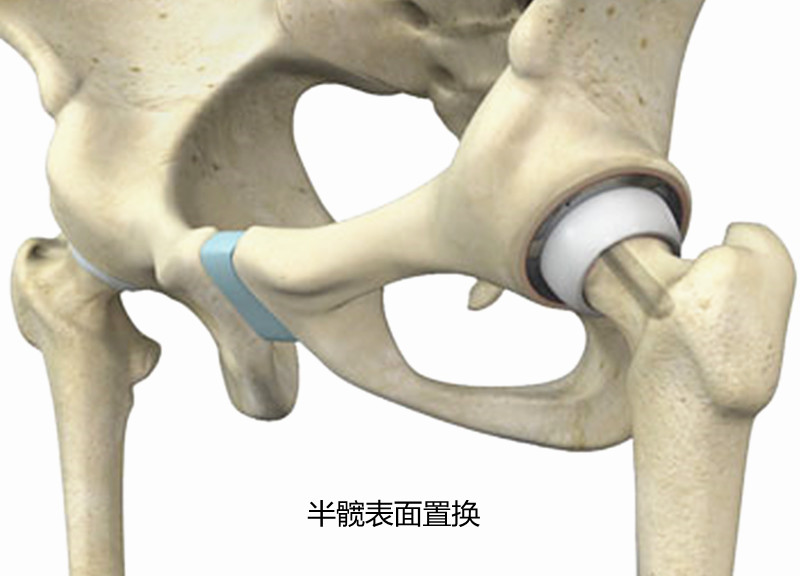 Should a total hip replacement be replaced?Doctor You can replace half