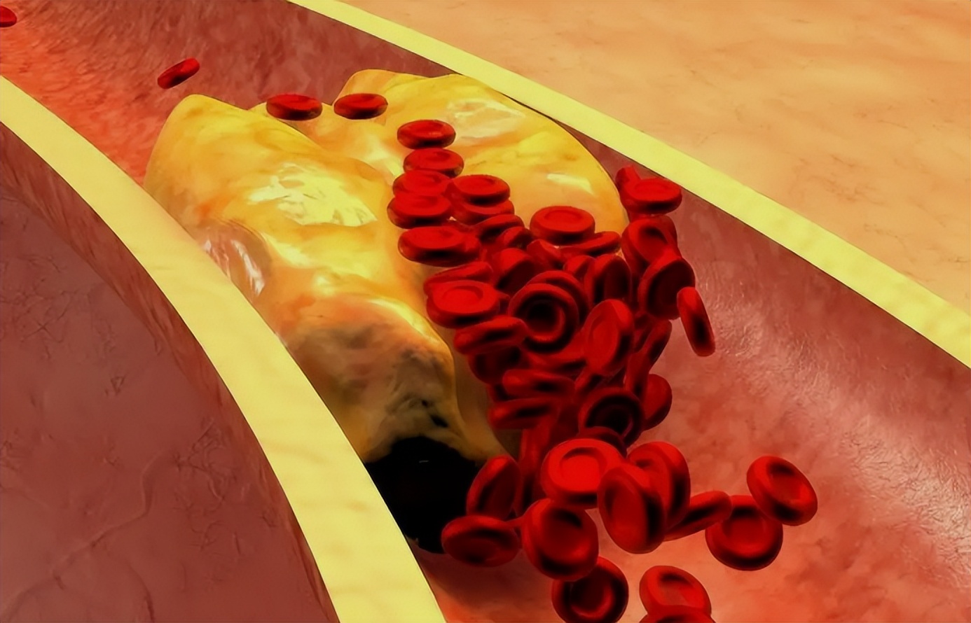 People with clean blood vessels live longer! It is to do 5