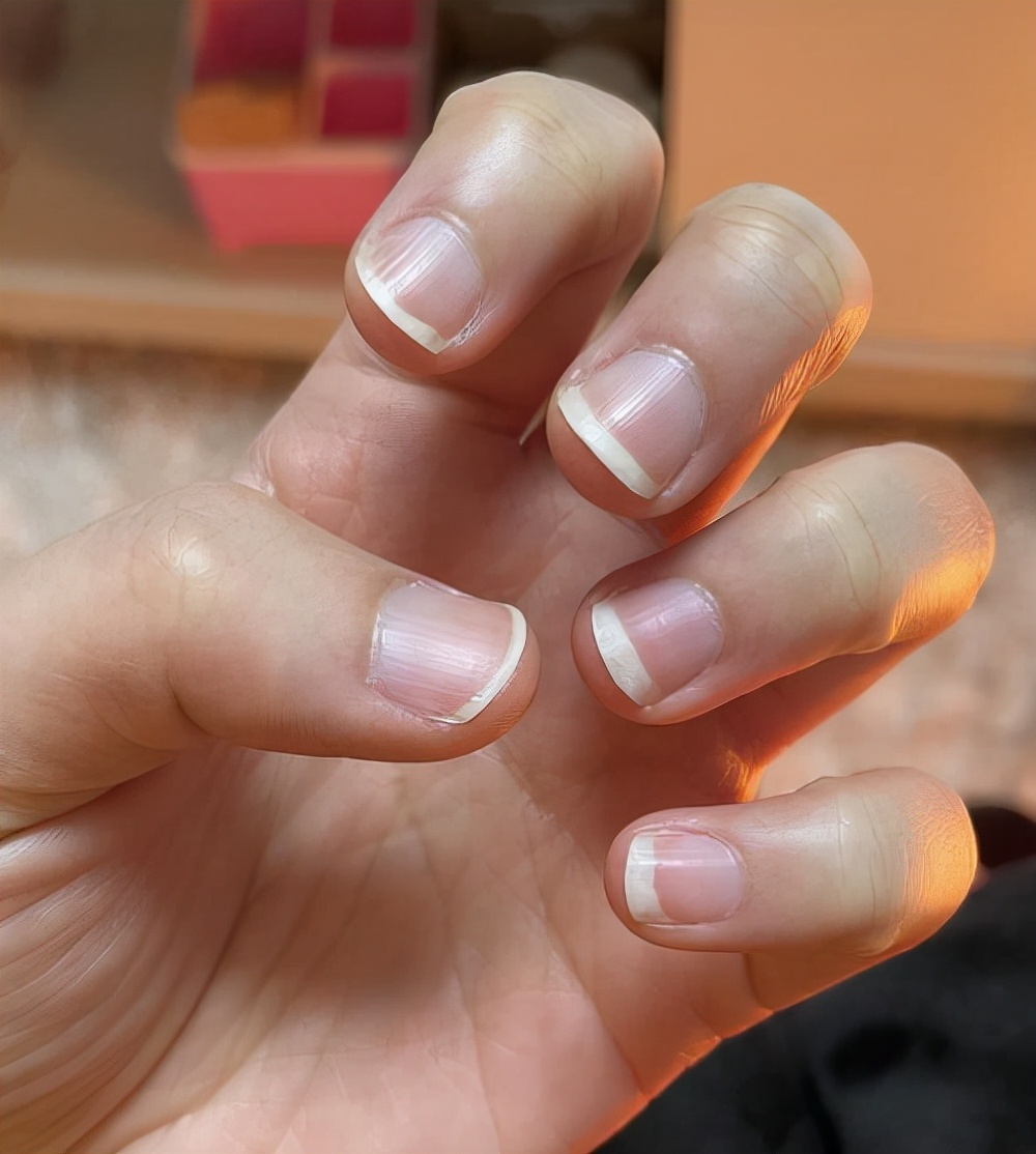 Why do fingernails have "vertical lines"?Several problems that often