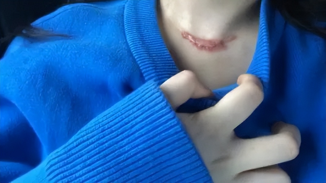 How many times does the scar acupuncture work?Can those scars be