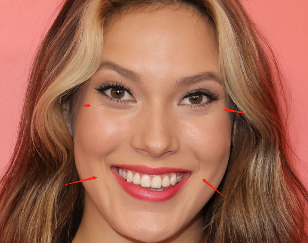 Gu Ailing has acne breakouts on her face due to frequent social ...