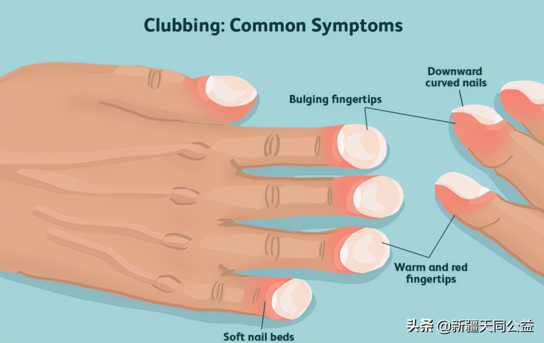 Understand the nail changes caused by AIDS iNEWS